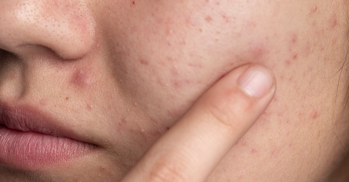 Difference Between Acne And Rosacea What You Need To Know 