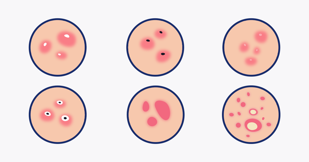Types Of Acne Treatment & Foods That Can Cause Acne Ova SG