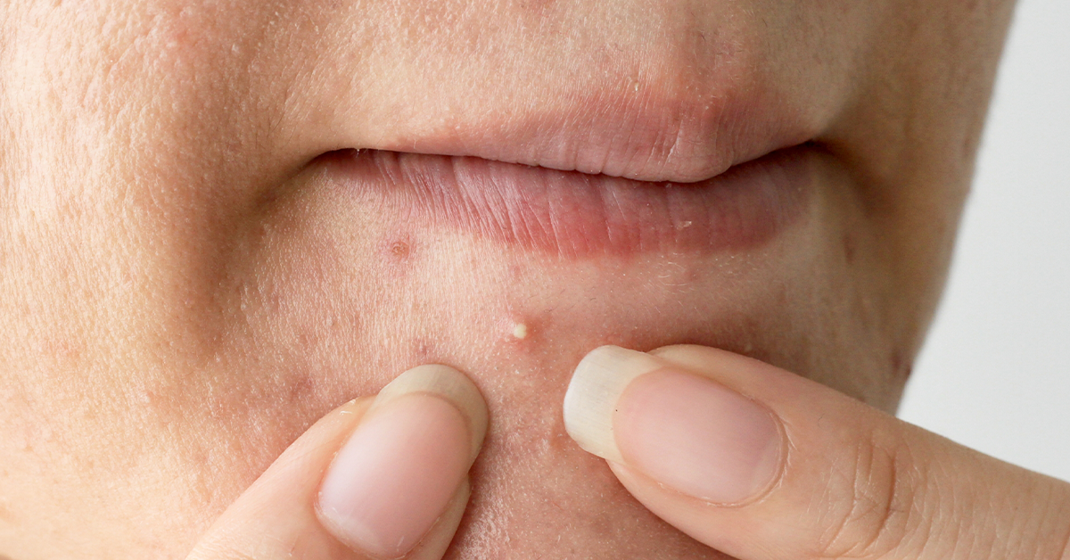 Whiteheads Causes, Symptoms, And Treatments Ova SG