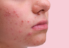 Fungal acne (Malassezia Folliculitis, Pityrosporum Folliculitis): How to treat? fungal acne