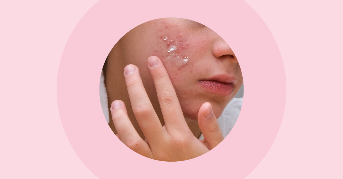 8-ways-to-treat-acne-breakout-in-women-ova-sg