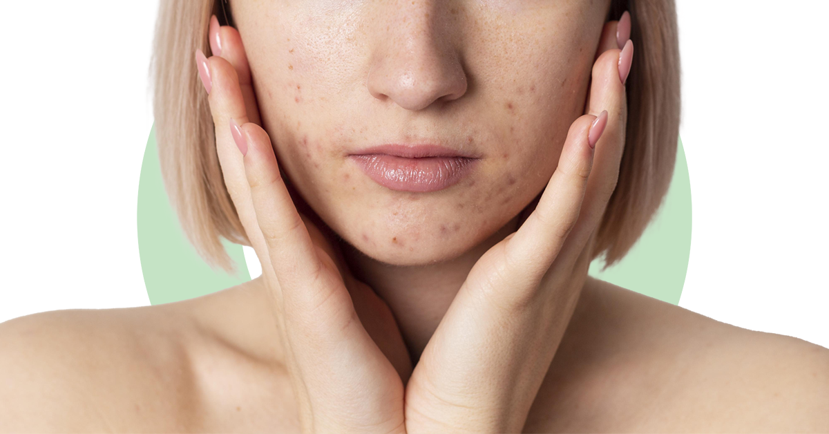 hormonal-acne-types-causes-and-treatment-ova-sg