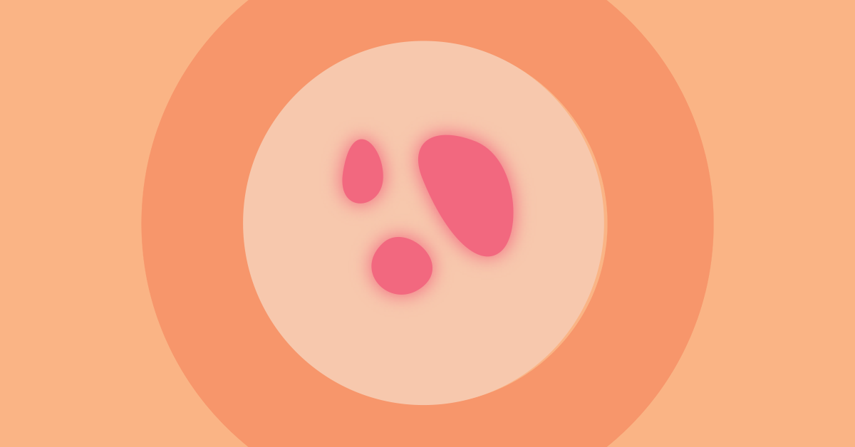 Nodular Acne Causes, Treatment And Prevention Tips Ova SG